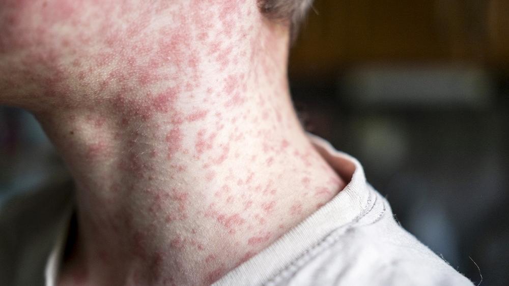 Measles