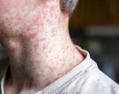 Measles