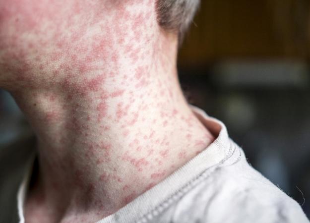 Measles